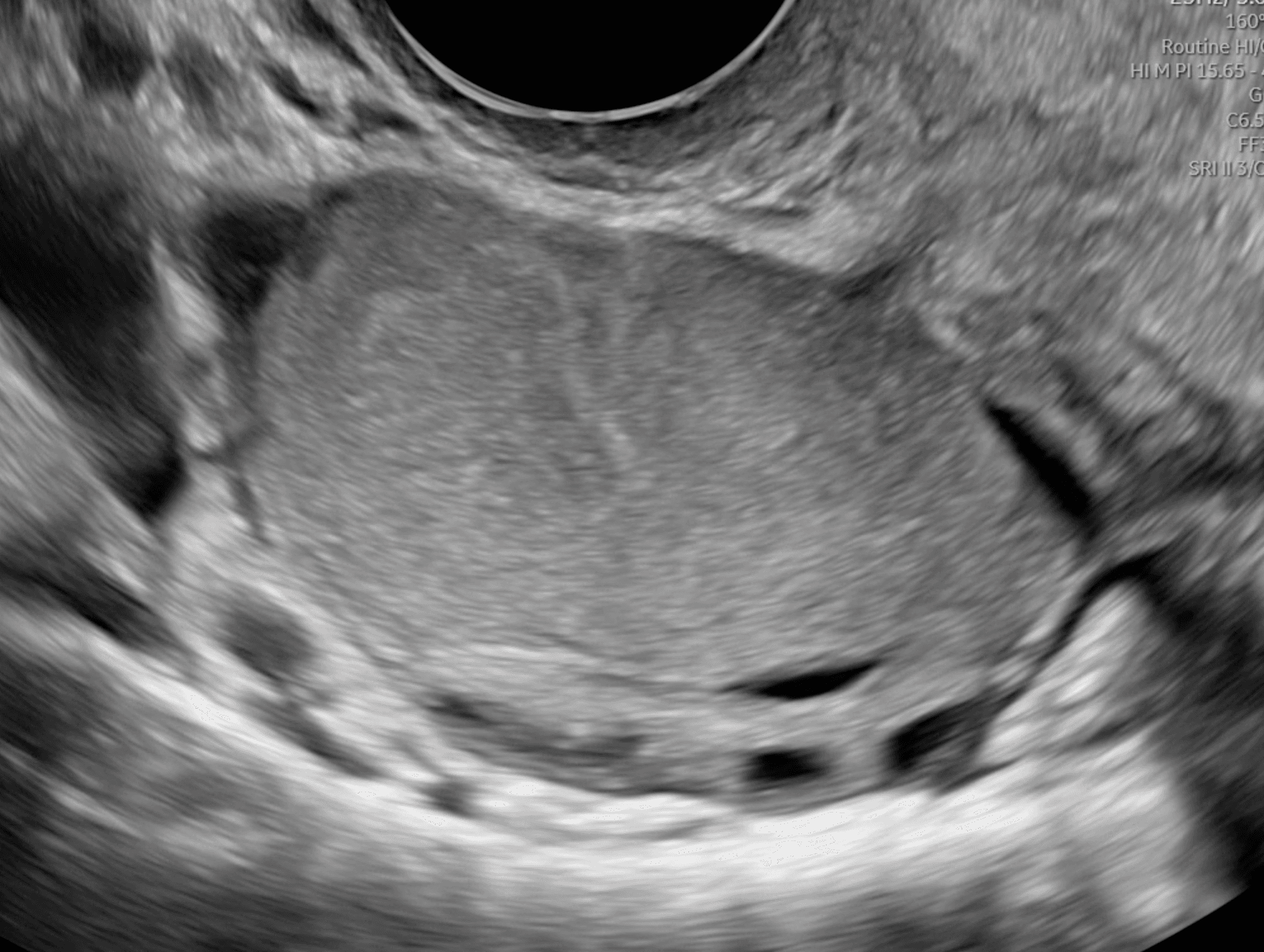 Cisti endometriosica (endometrioma ovarico)